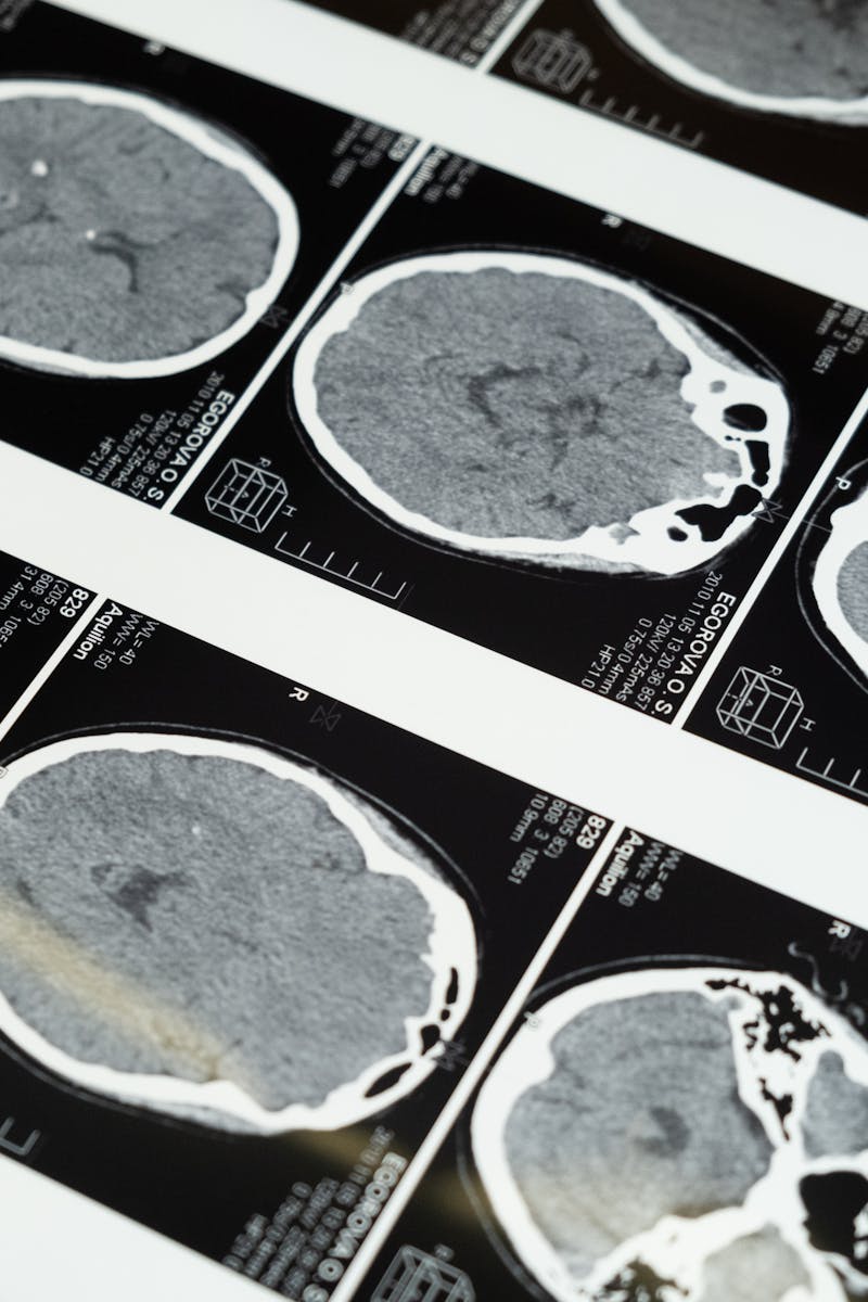 Detailed brain MRI scans displayed on a lightbox, showcasing medical imaging techniques.